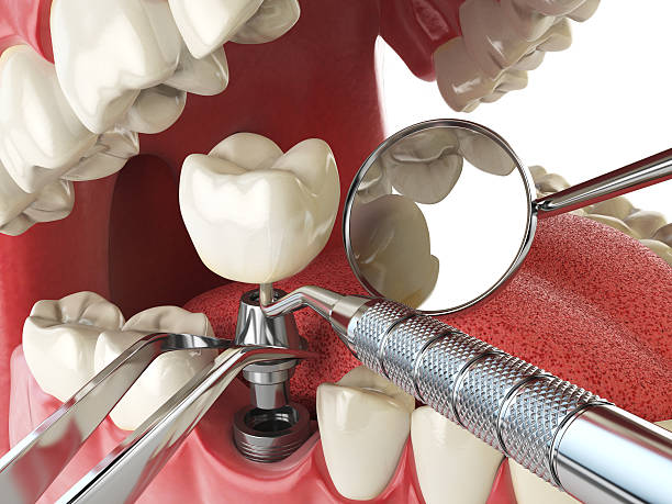 Best Emergency Wisdom Teeth Removal in Olivia, MN
